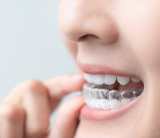 Closeup of patient putting on clear aligner