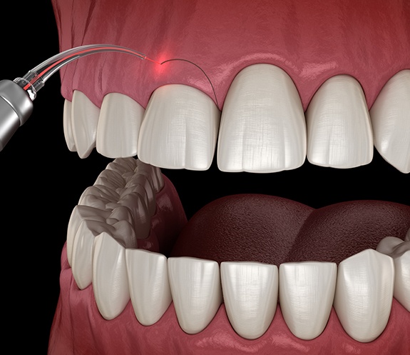 Animated smile during gum recontouring treatment