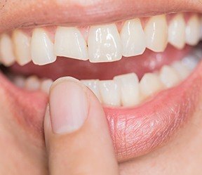 Closeup of smile with chipped or broken tooth