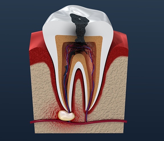 Animated tooth with damage and decay before root canal therapy