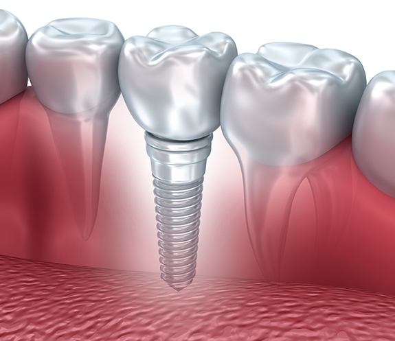 Animated smile after dental implant supported dental crown placement