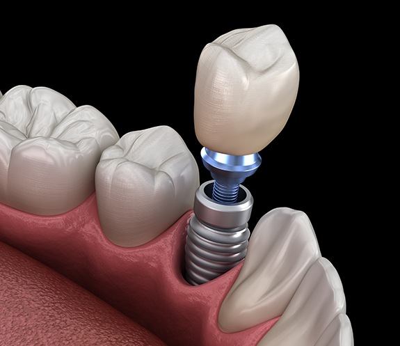 Animated smile during dental implant placement