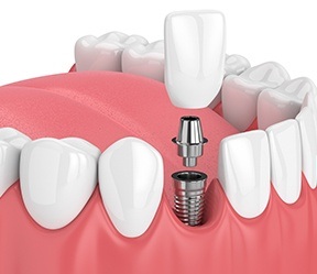 Animated smile during dental implant supported dental crown placement