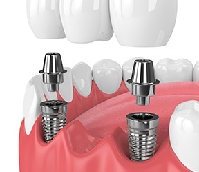 Animated smile during dental implant supported fixed bridge placement