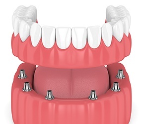Animated smile during dental implant supported denture placement