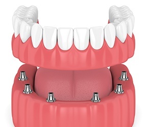 Animated smile during dental implant supported denture placement