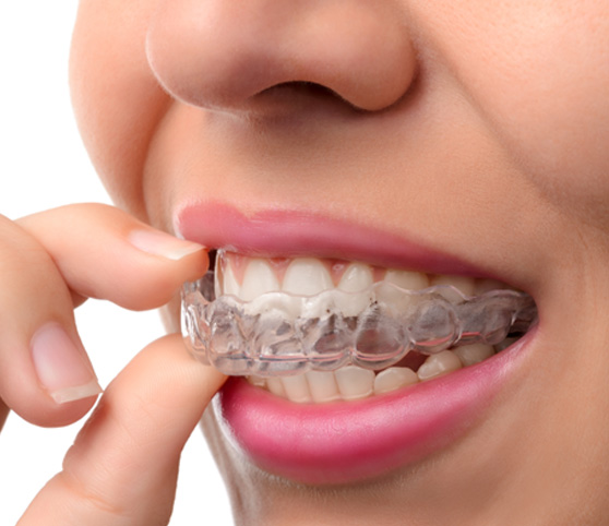 Nose-to-chin closeup of woman putting Invisalign over upper arch