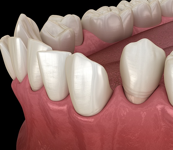Illustration of gapped teeth