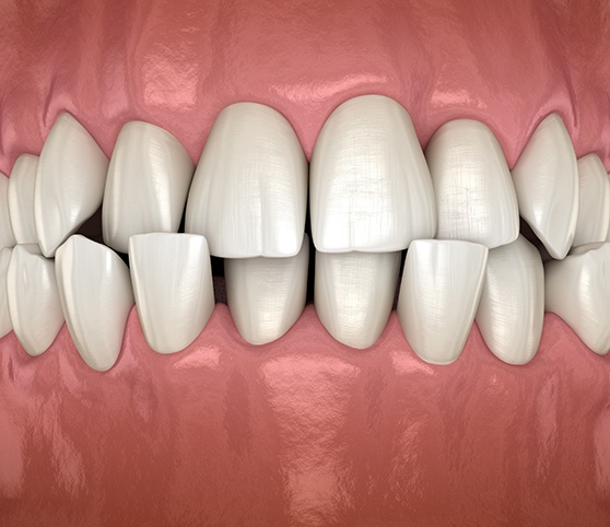 Illustration of a crossbite
