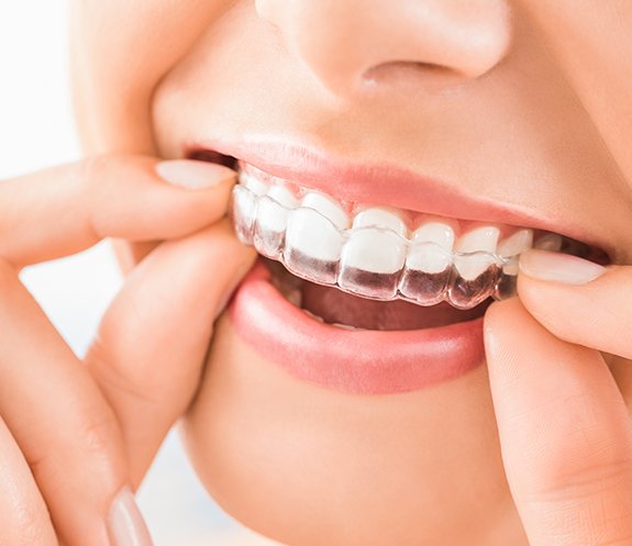Closeup of patient placing Invisalign clear braces tray