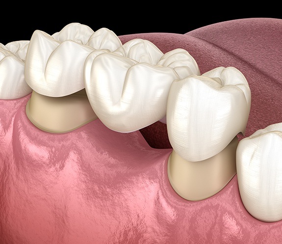 Animated smile during dental bridge placement