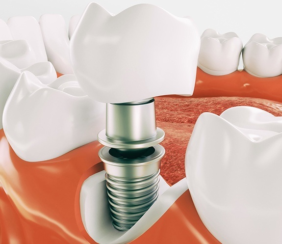 Animated smile during dental implant placement
