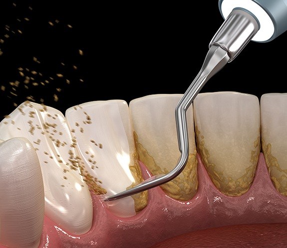 Animated smile during scaling and root planing treatment