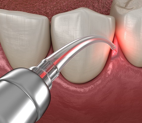 Animated smile during laser periodontal therapy