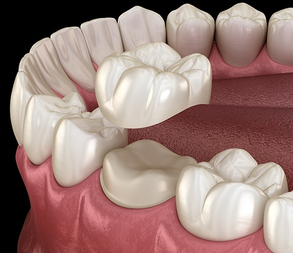 Animated smile during dental crown placement