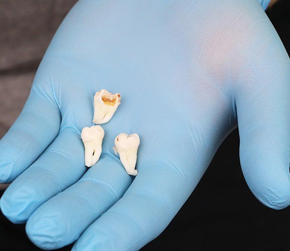Dentist holding wisdom teeth after extractions
